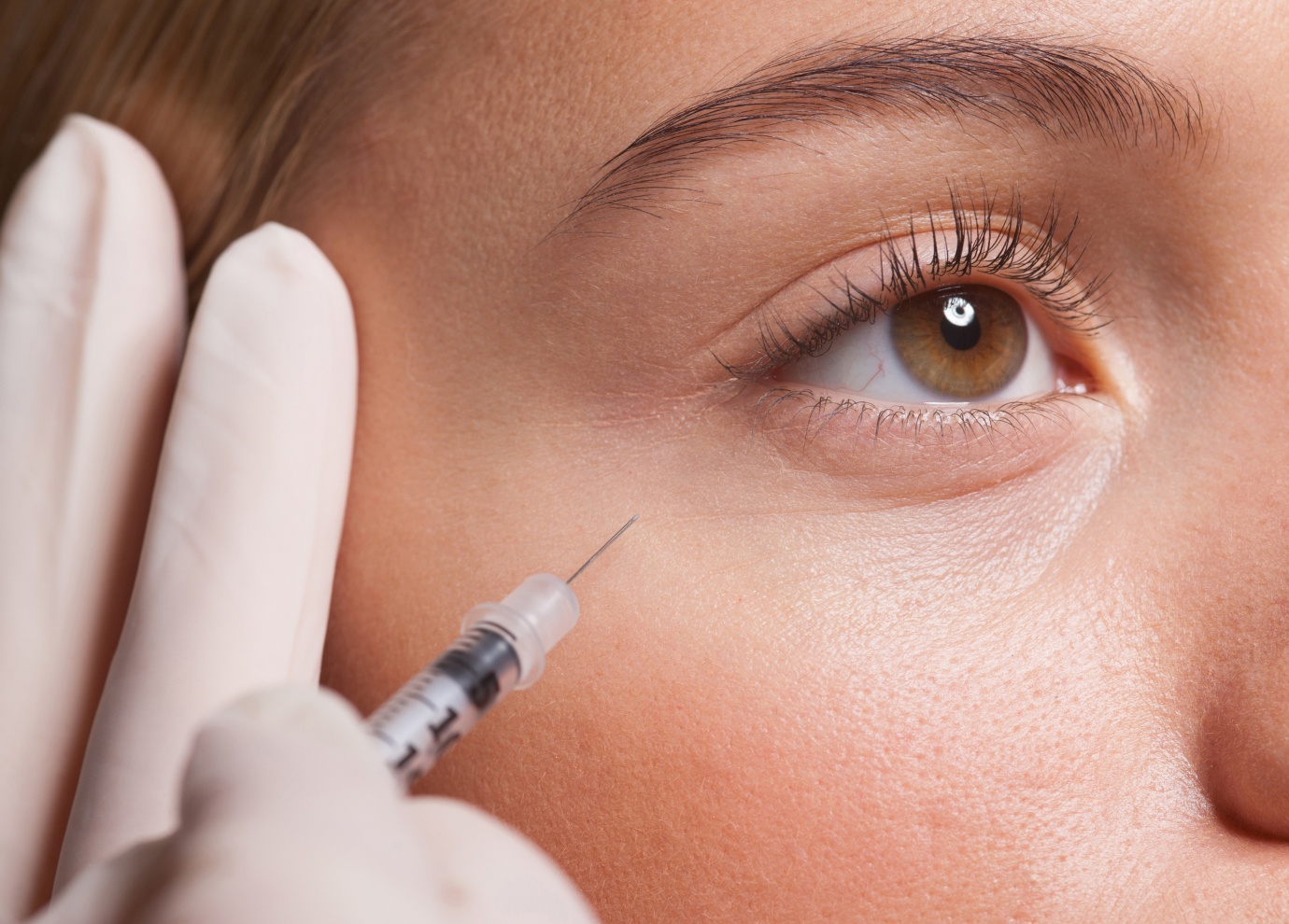 Acide hyaluronique cernes à Toulouse | Tarifs | Centre médecine esthétique G&S